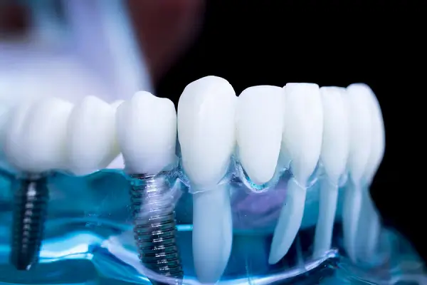 Uso de coronas dentales
