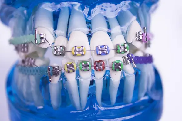 Beneficios inesperados de los brackets