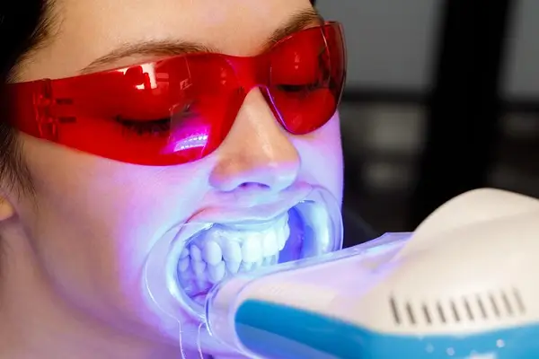 Blanqueamiento dental por fotoactivación un método efectivo y popular