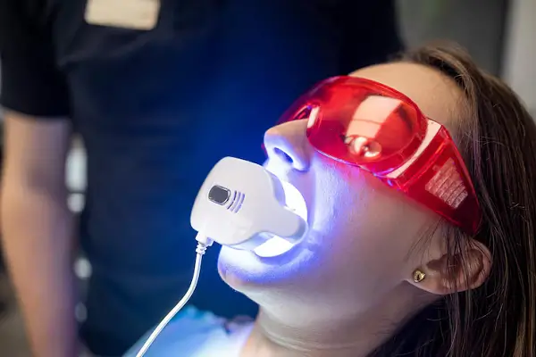 Cómo se realiza el blanqueamiento dental por fotoactivación