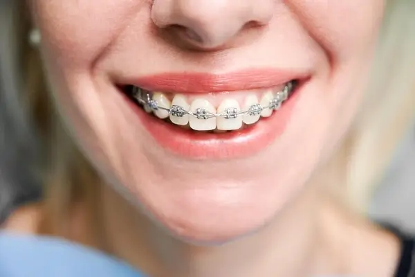 Los mejores tratamientos de brackets