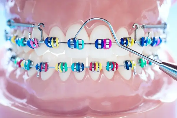 Mantenimiento de los Brackets Metálicos