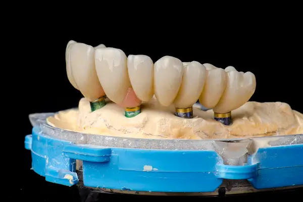 Mejorar la estética dental