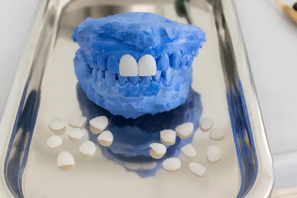 Soluciones de composite para dientes desgastados