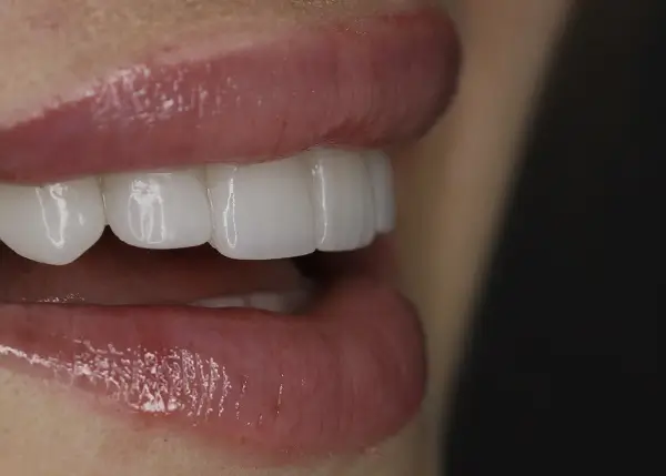 coronas dentales madrid 